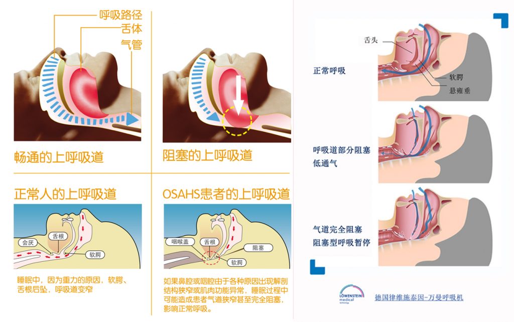 這(zhè)次了(le)解下(xià)什(shén)麽是(shì)中樞性睡(shuì)眠呼吸暫停⏸️和(hé)阻塞性睡(shuì)眠呼吸暫停的(de)區(qū)别